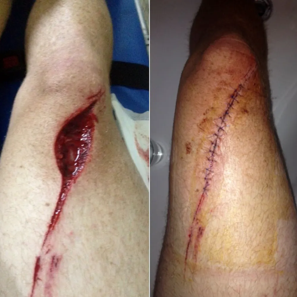 Bodyboarding Injuries