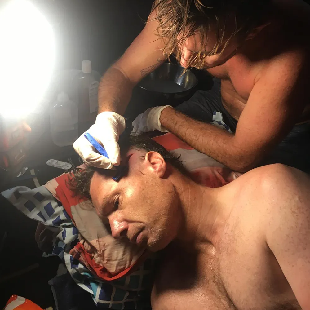 Bodyboarding Injuries